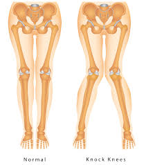Knock Knee Illustration